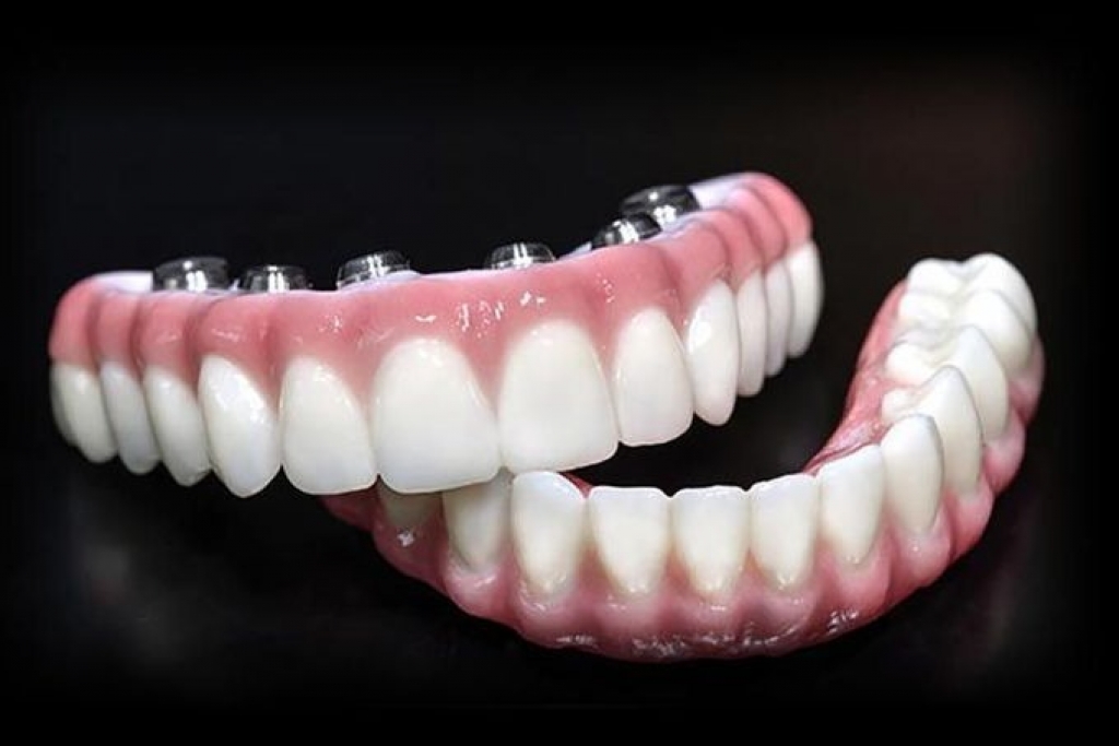 All-on-4全口重建為何比活動假牙及一般植牙更佔優勢?