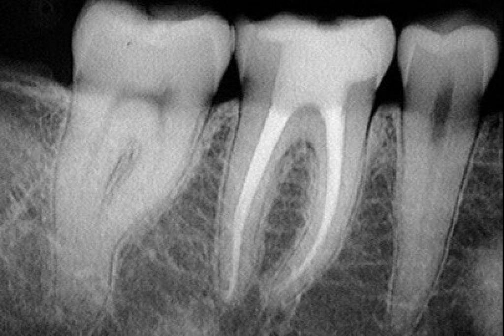 為什麼根管治療完的牙齒一定要做牙冠? 是因為根管沒治療好嗎?
